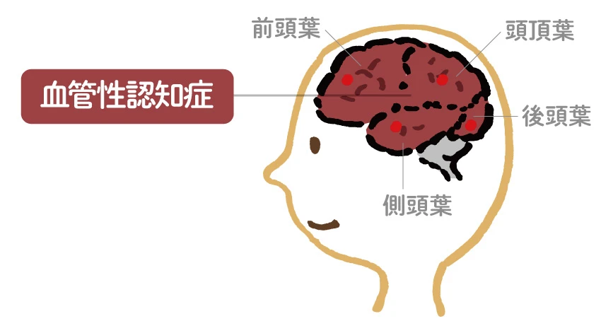 血管性認知症を専門医が徹底解説 原因、治療、知っておきたい“予防法”