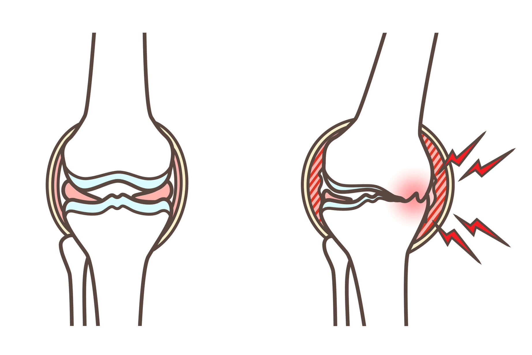 【柴先生監修】40代で膝が痛いときの原因とは？症状や診断・治療方法、予防策について紹介！