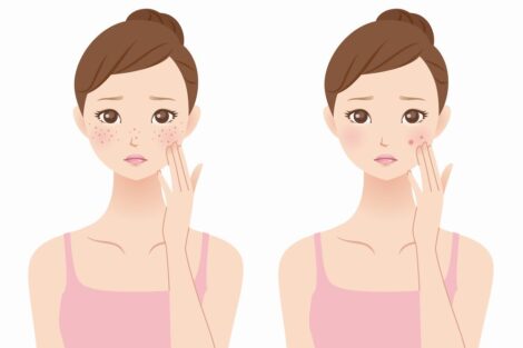 【必見】日焼け後の肌をケアする方法7選！やってはいけない対処法を紹介