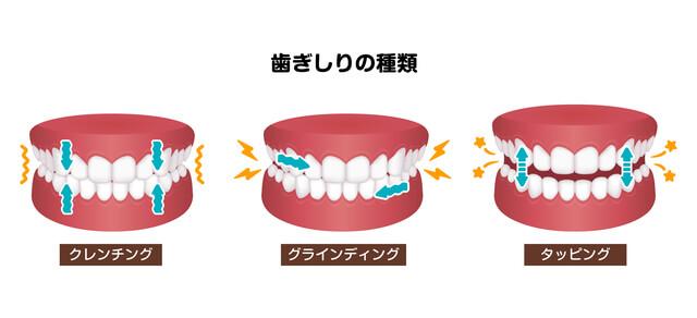 ３種類の歯ぎしり
