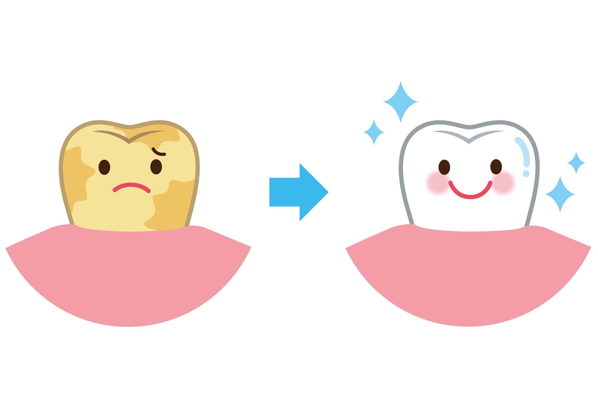 【医師監修】歯のホワイトニングのデメリットはある？金額や期間についても紹介