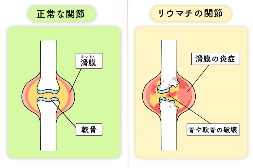 関節リウマチvs変形性関節症