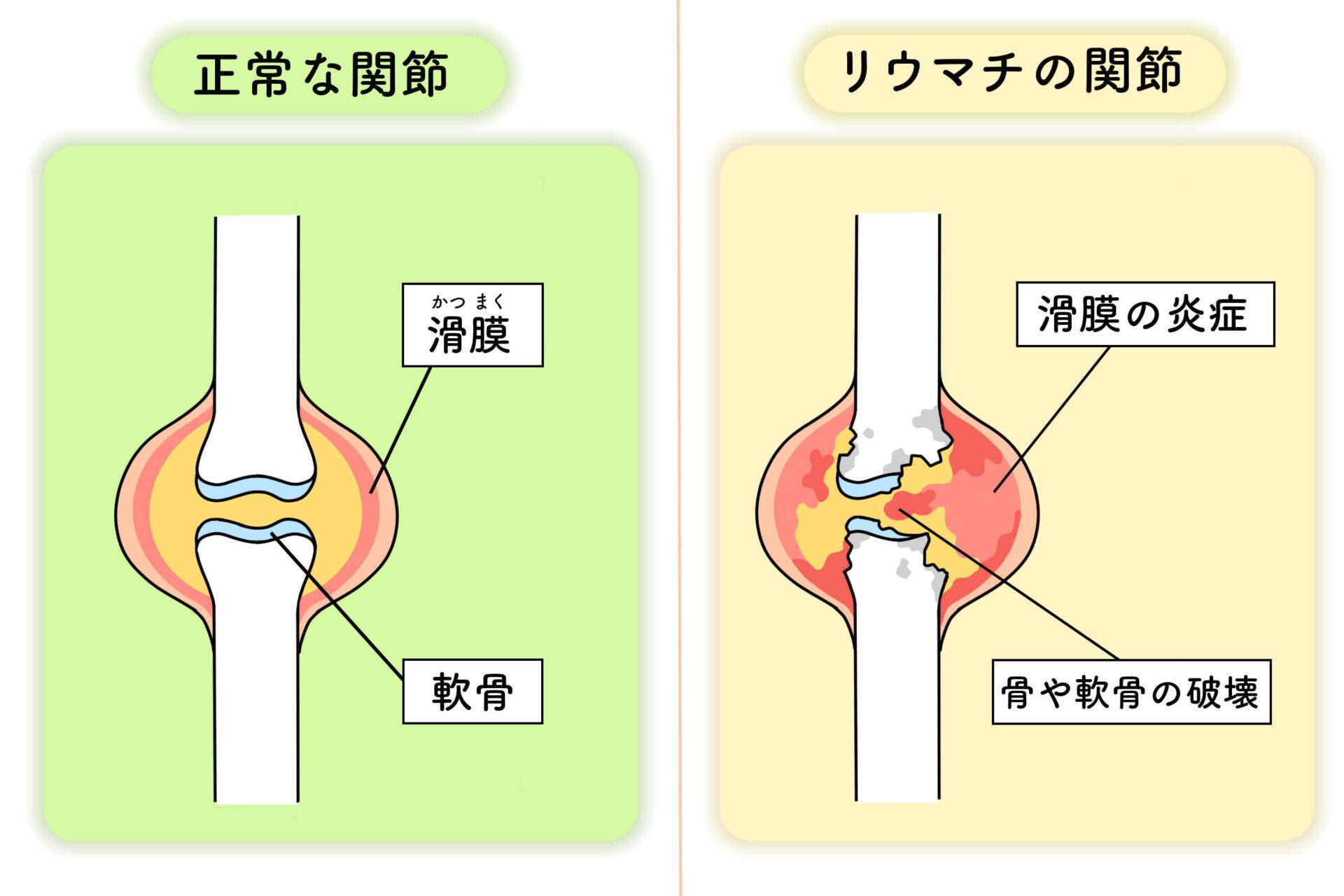 関節リウマチの発疹の症状は何ですか?