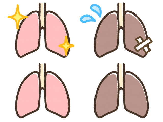 肺がんの治療方法