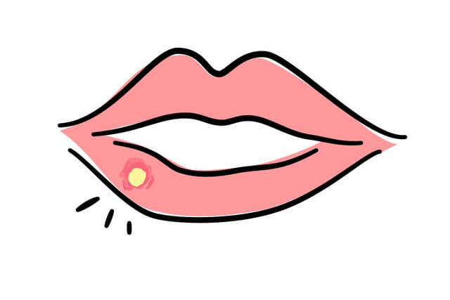口の中にできた白いできものは病気のサイン？病名から症状・治療の流れについて解説します