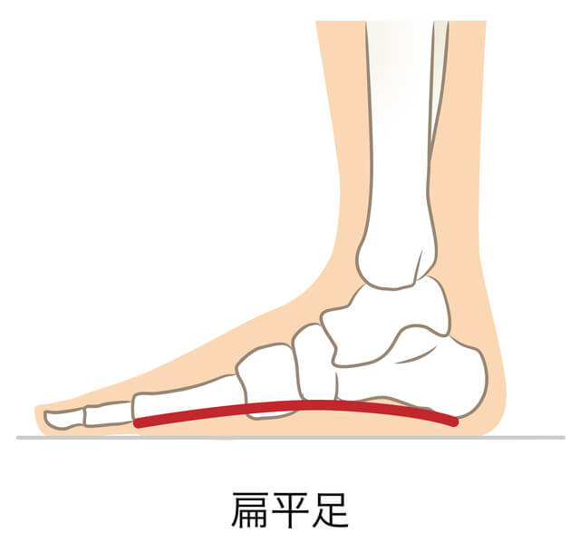 扁平足とは？原因とメカニズムを知ろう