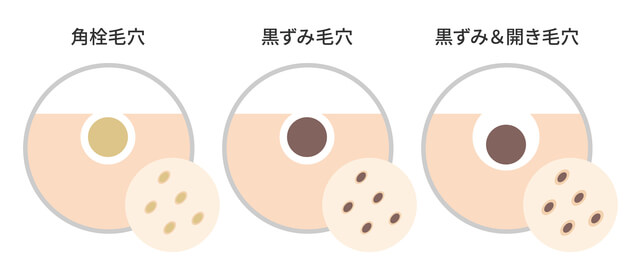 毛穴が目立ってしまう原因とは？